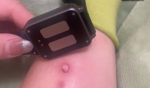 女生为考研戴电击手表叫起床被电伤：睡了12小时没被叫醒
