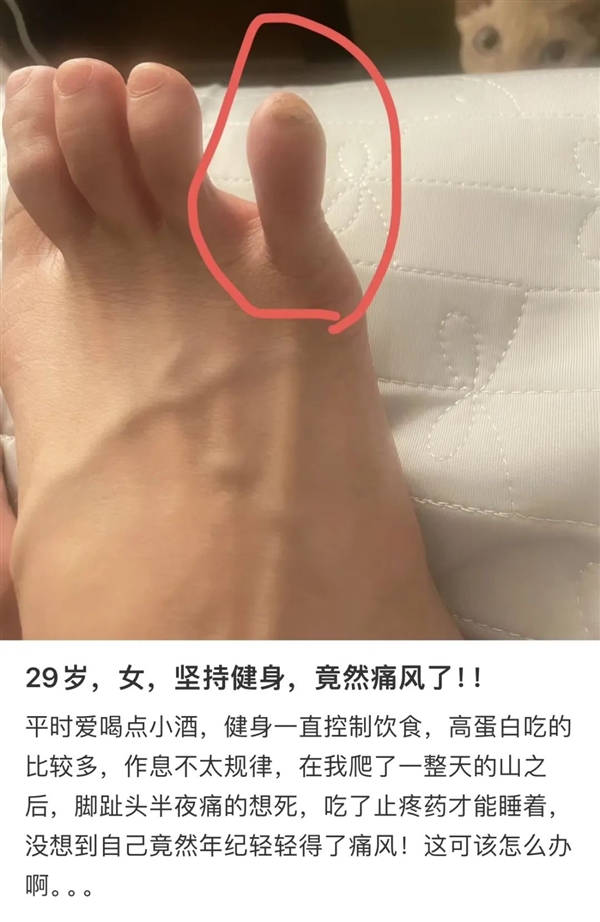 第一批95后 已经开始痛风了