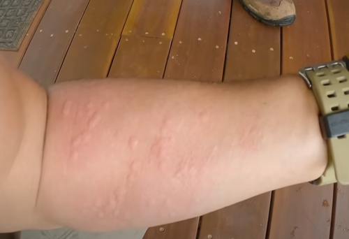 用这种叶子擦屁股 疼到开枪自杀！碰一下就痛不欲生 持续2年