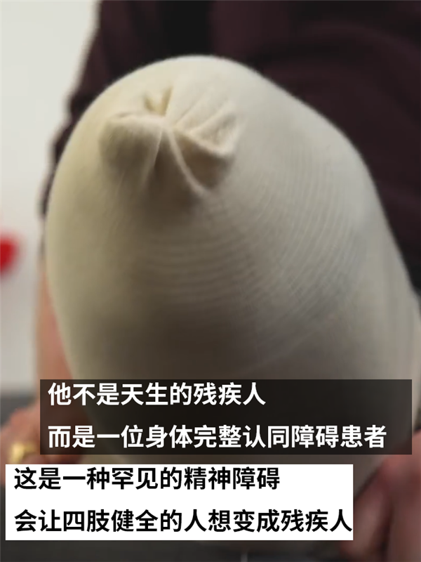 主动锯掉自己健康的大腿！只因患上了身体完整认同障碍