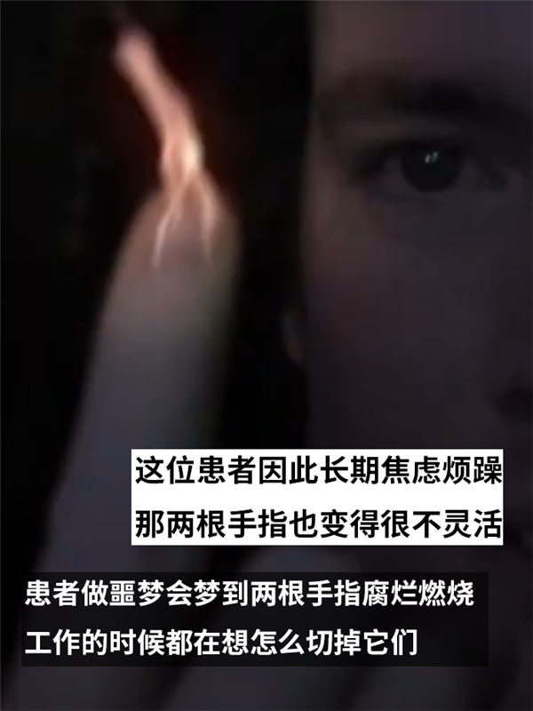 主动锯掉自己健康的大腿！只因患上了身体完整认同障碍