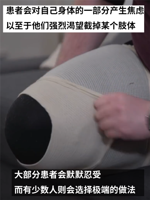 主动锯掉自己健康的大腿！只因患上了身体完整认同障碍