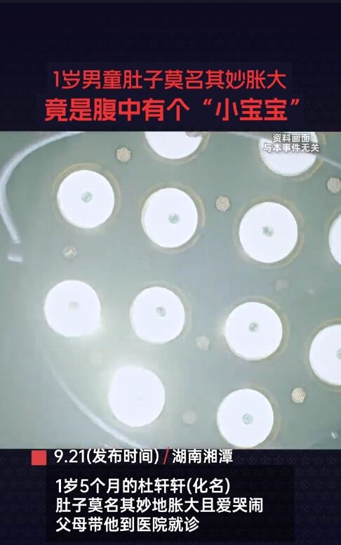 1岁男童腹中竟有个小宝宝：医学罕见