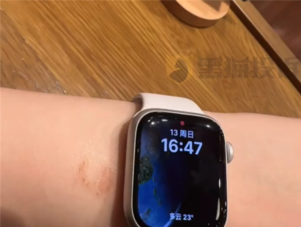 女子戴Apple Watch睡觉被烫伤起泡 苹果客服回应:过敏反应