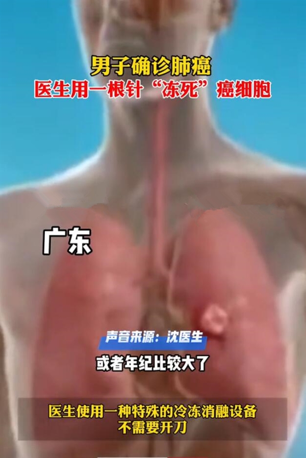 男子确诊肺癌：医生一根针冻死癌细胞
